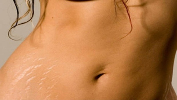 stretch marks scars remove natural remedies skin march