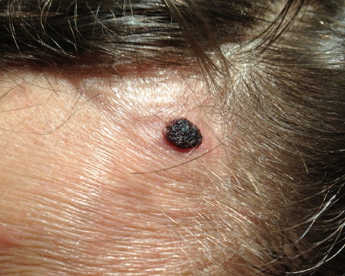 moles rid vinegar cider apple skin healthy